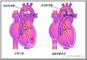第一篇：动脉导管未闭（PDA）