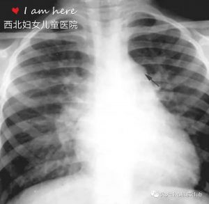第一篇：动脉导管未闭（PDA）