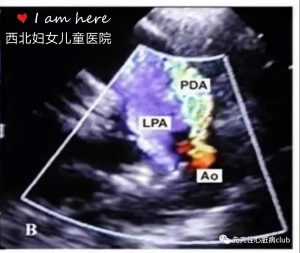 第一篇：动脉导管未闭（PDA）
