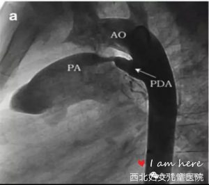 第一篇：动脉导管未闭（PDA）