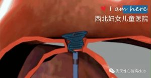 第一篇：动脉导管未闭（PDA）