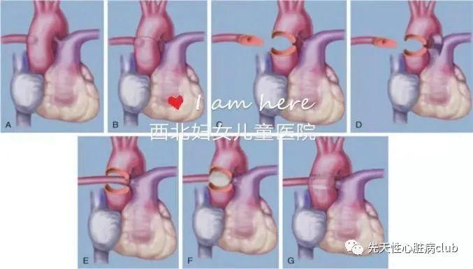 第二十篇:一侧肺动脉起源于升主动脉（AOPA)