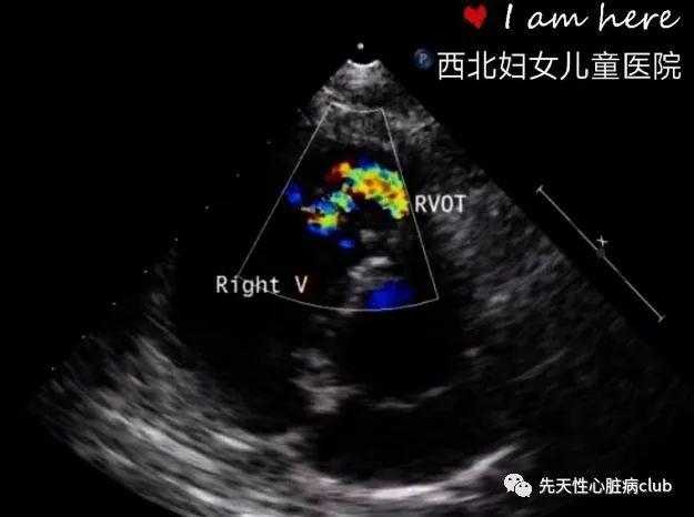 第十六篇：右室双腔