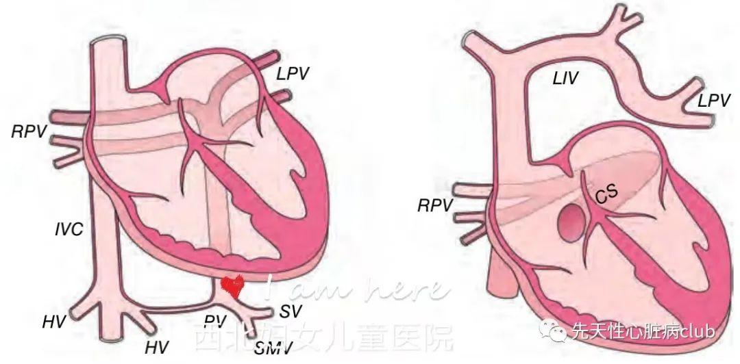 第二十五篇:完全性肺静脉异位引流（TAPVC）