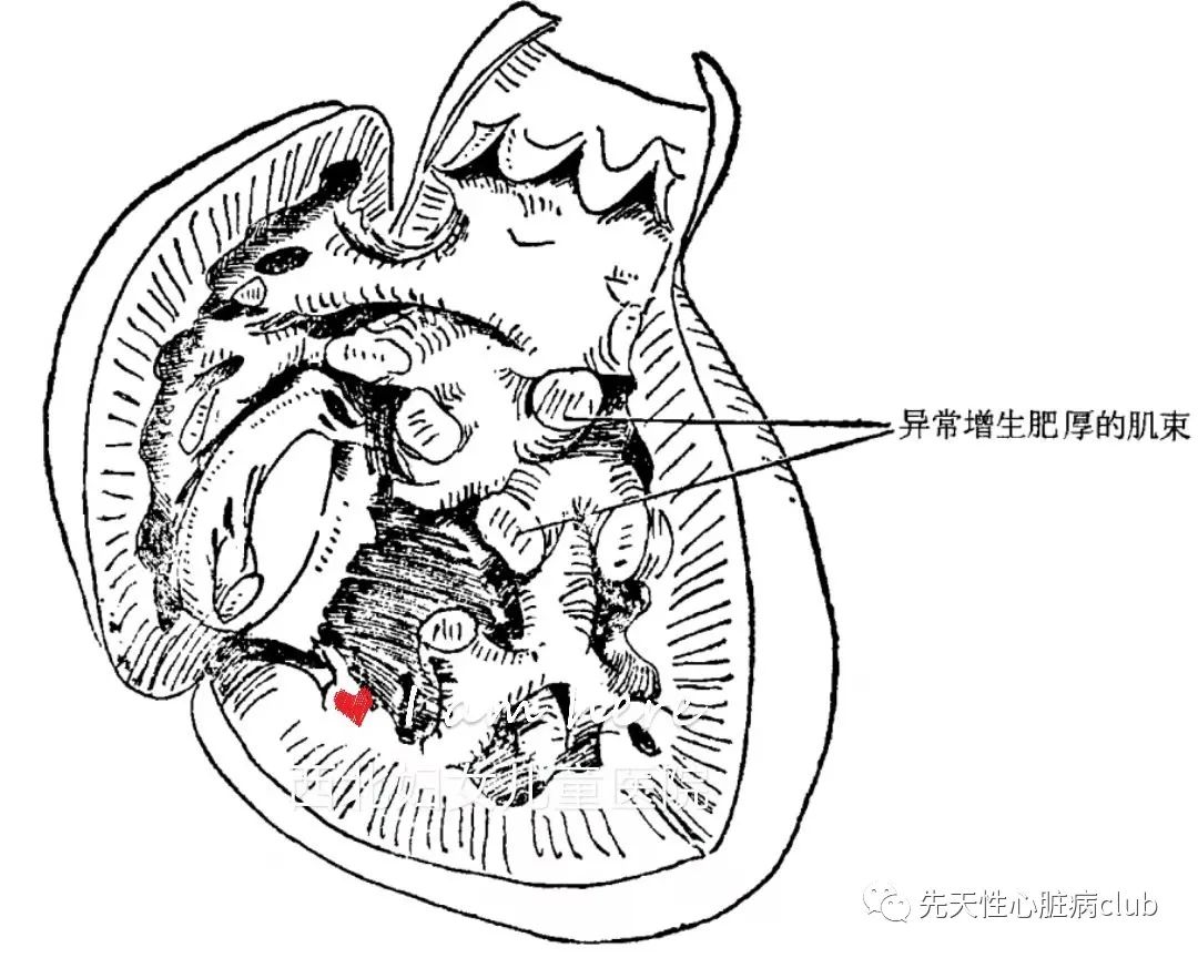 第十六篇：右室双腔