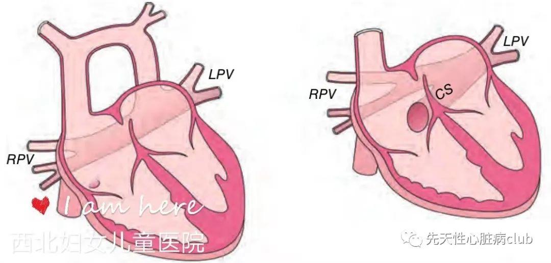 第二十五篇:完全性肺静脉异位引流（TAPVC）