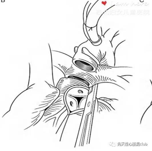 第二十二篇：矫正性大动脉转位（CTGA）