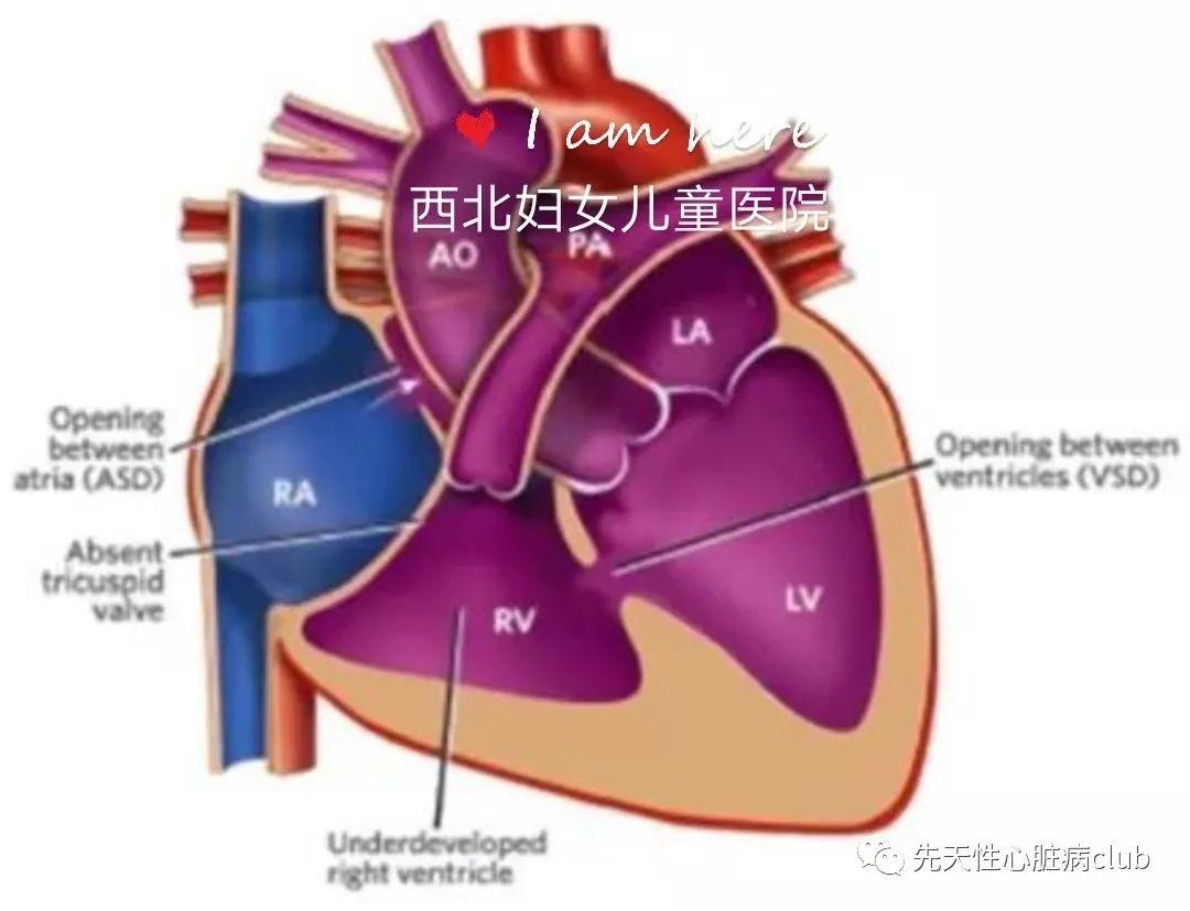 第十八篇：三尖瓣闭锁（TA）