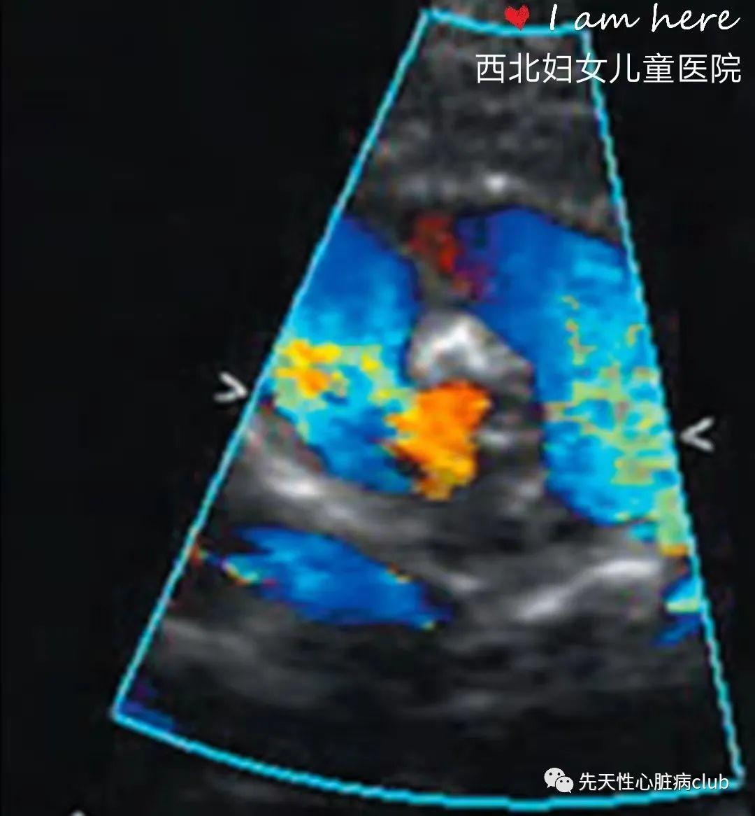 第十三篇：血管环和肺动脉吊带
