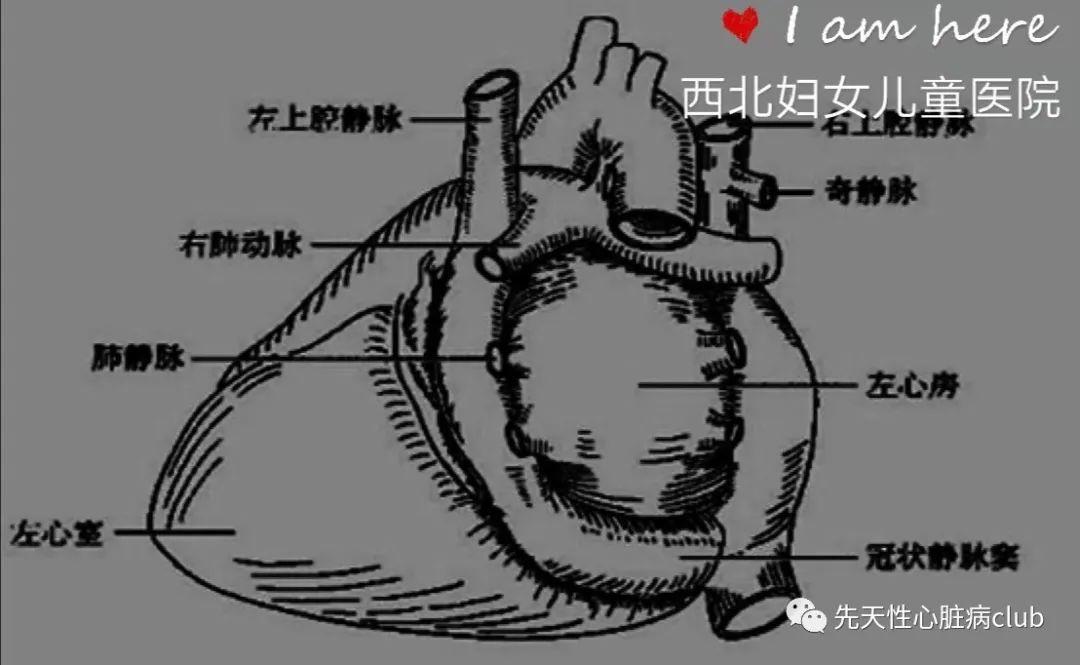 第十九篇：无顶冠状静脉窦综合征（UCSS）