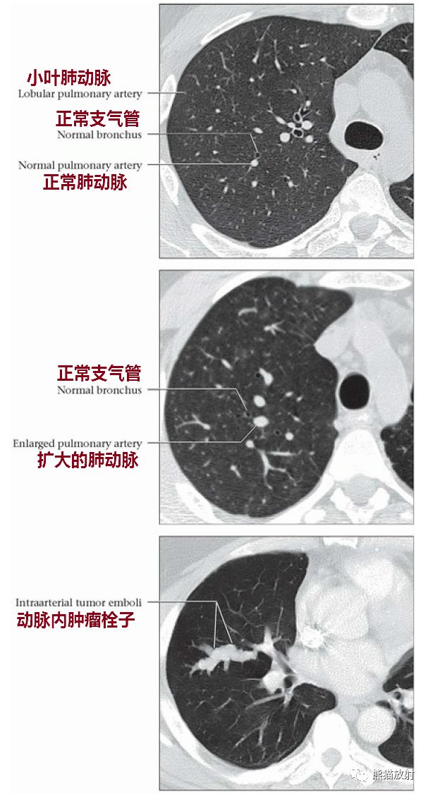 收藏丨肺动脉解剖、正常及部分异常影像