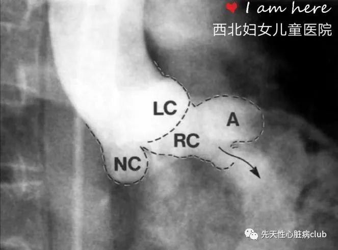 第二十一篇：主动脉窦瘤破裂（RSVA)