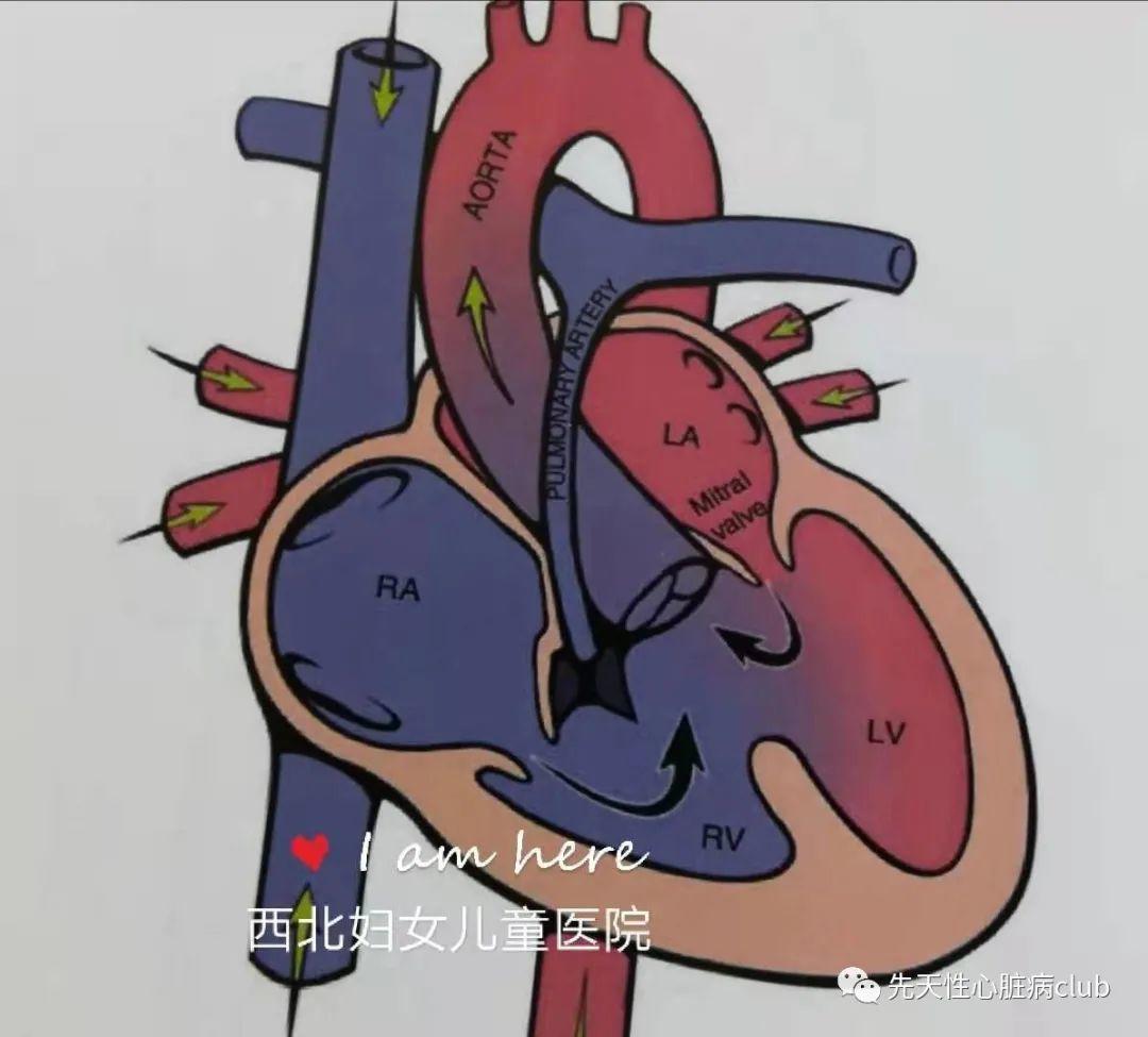 第十一篇：肺动脉闭锁合并室间隔缺损（PA/VSD）