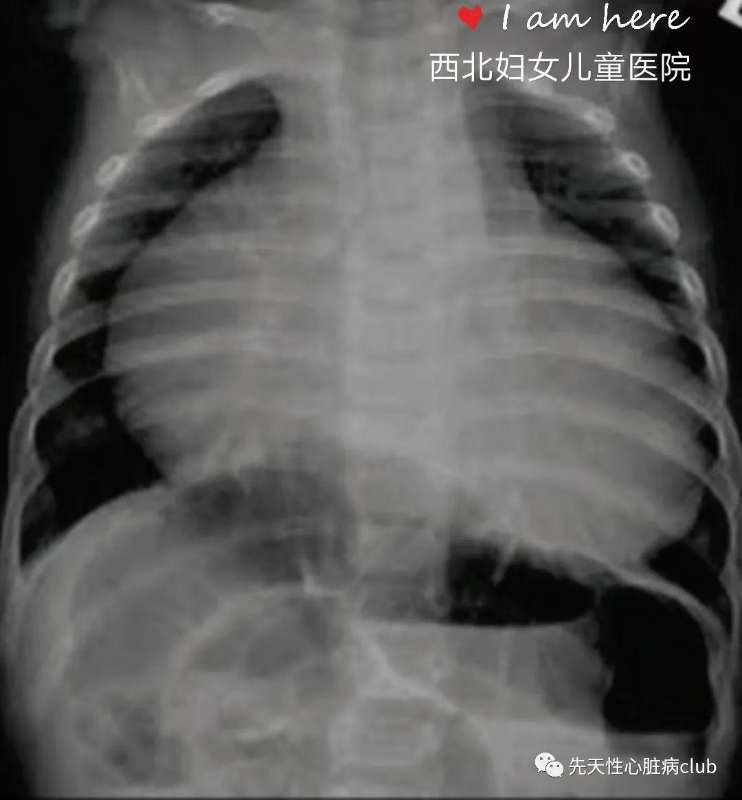 第十七篇：三尖瓣下移畸形