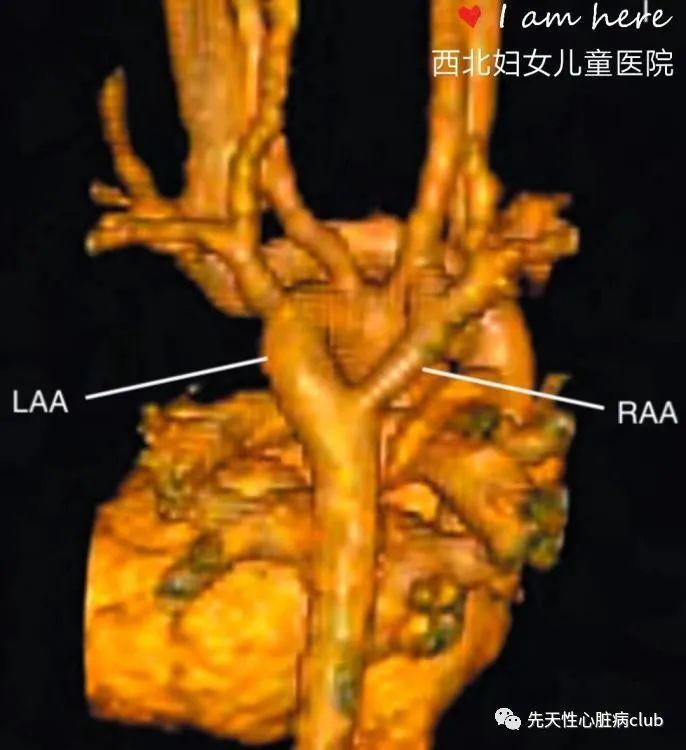 第十三篇：血管环和肺动脉吊带