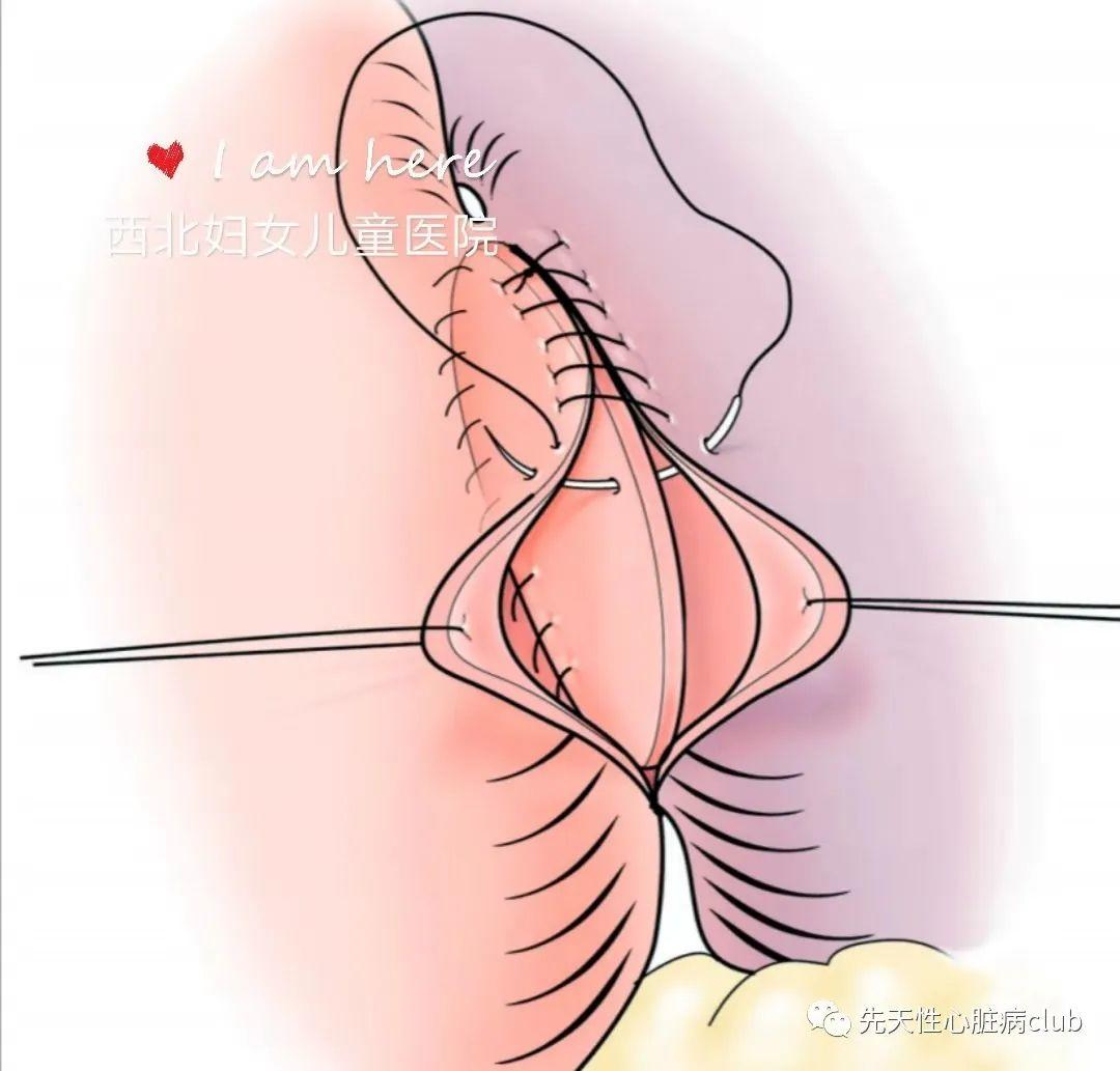 第十五篇：主肺动脉窗
