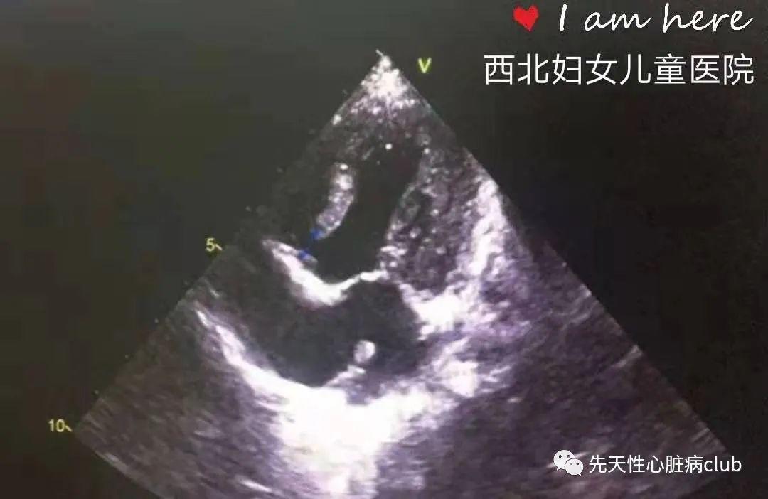 第十八篇：三尖瓣闭锁（TA）