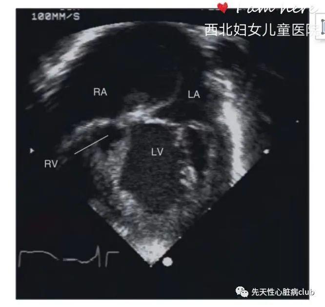 第十二篇：室间隔完整型肺动脉闭锁