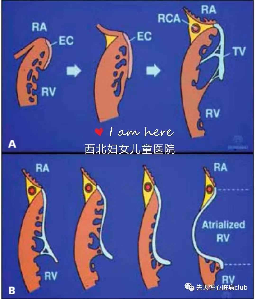 第十七篇：三尖瓣下移畸形