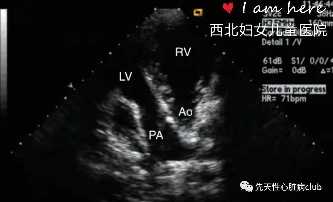 第二十二篇：矫正性大动脉转位（CTGA）
