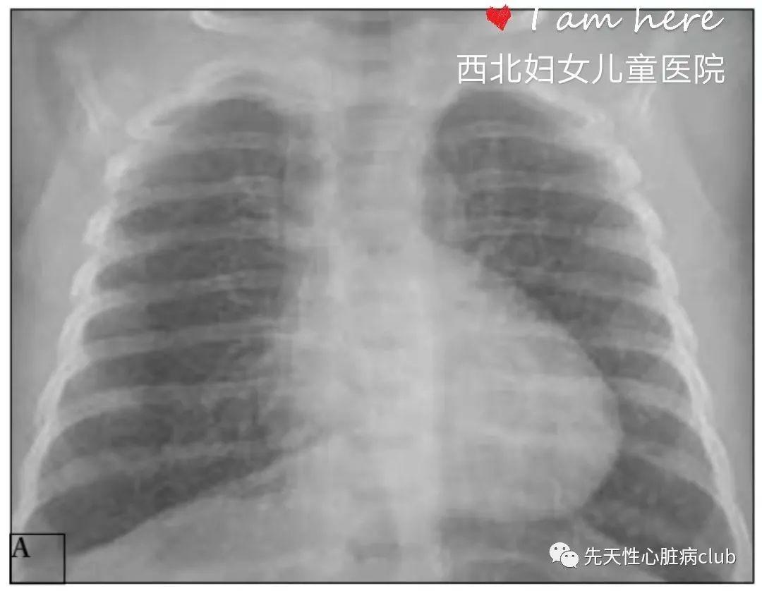 第十一篇：肺动脉闭锁合并室间隔缺损（PA/VSD）