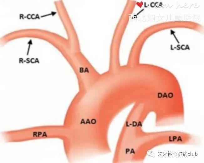第二十篇:一侧肺动脉起源于升主动脉（AOPA)