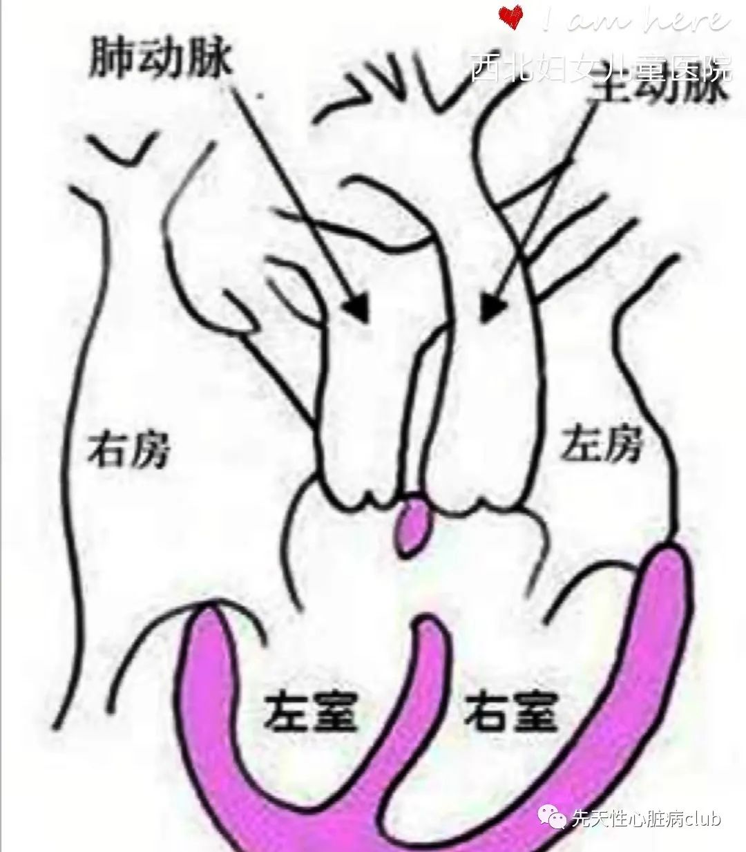第二十二篇：矫正性大动脉转位（CTGA）