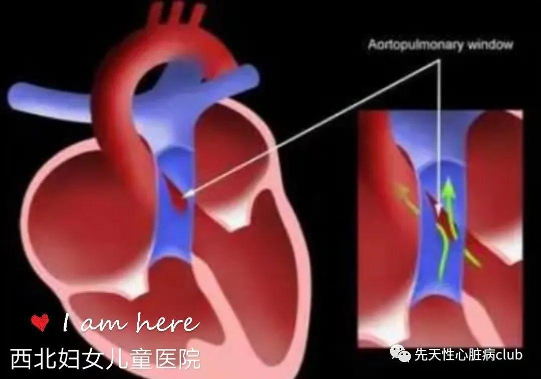 第十五篇：主肺动脉窗
