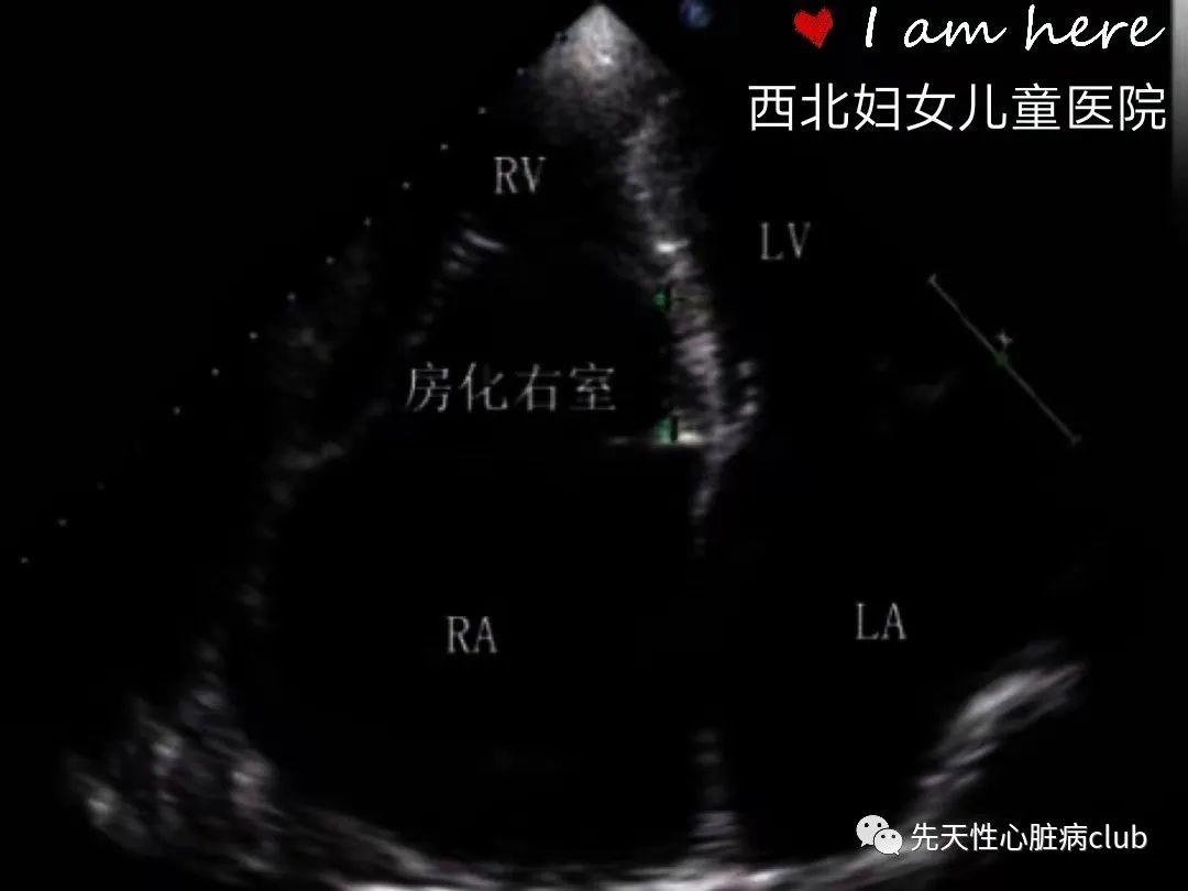 第十七篇：三尖瓣下移畸形