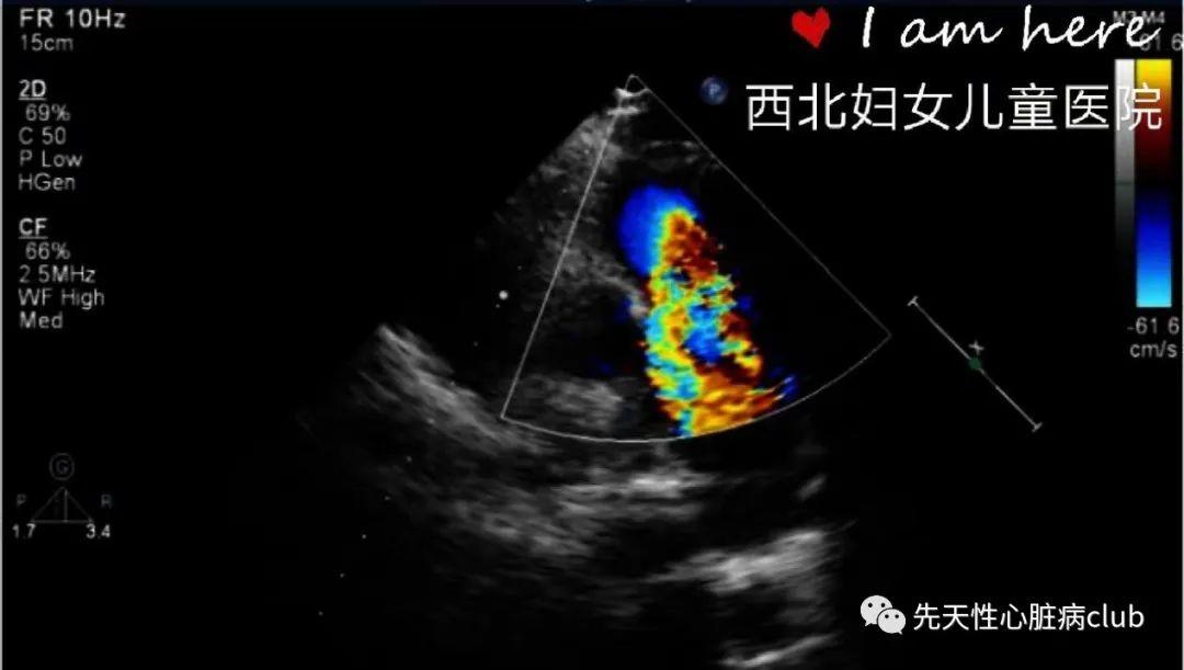 第十篇：肺动脉狭窄（PS）