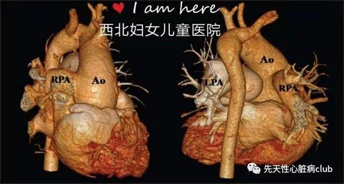 第二十篇:一侧肺动脉起源于升主动脉（AOPA)