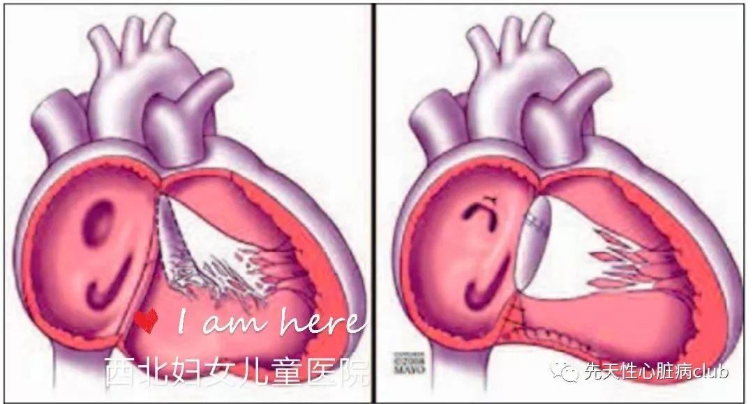 第十七篇：三尖瓣下移畸形