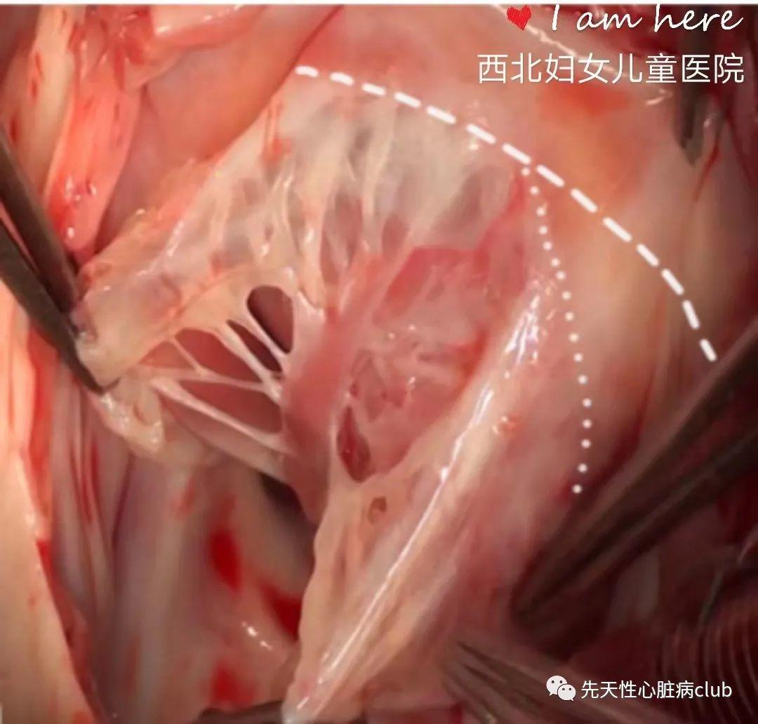 第十七篇：三尖瓣下移畸形