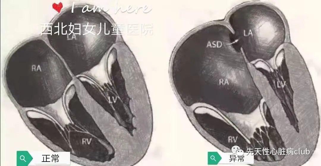 第十七篇：三尖瓣下移畸形