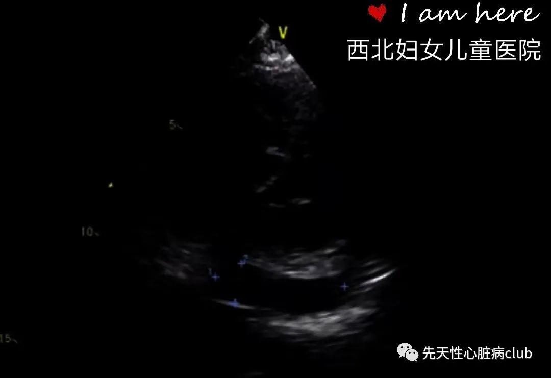 第十九篇：无顶冠状静脉窦综合征（UCSS）