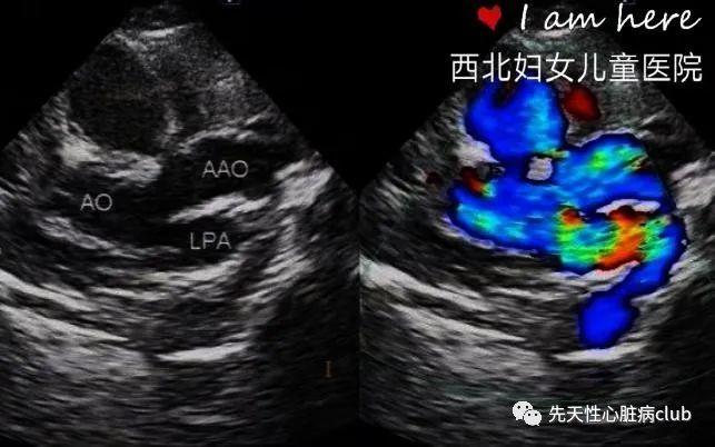 第二十篇:一侧肺动脉起源于升主动脉（AOPA)