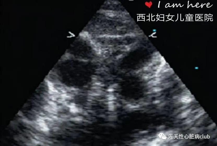 第十三篇：血管环和肺动脉吊带