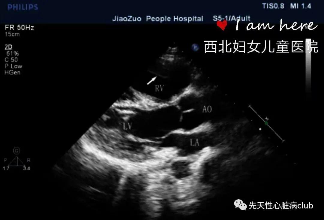 第十篇：肺动脉狭窄（PS）