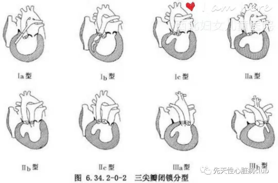 第十八篇：三尖瓣闭锁（TA）