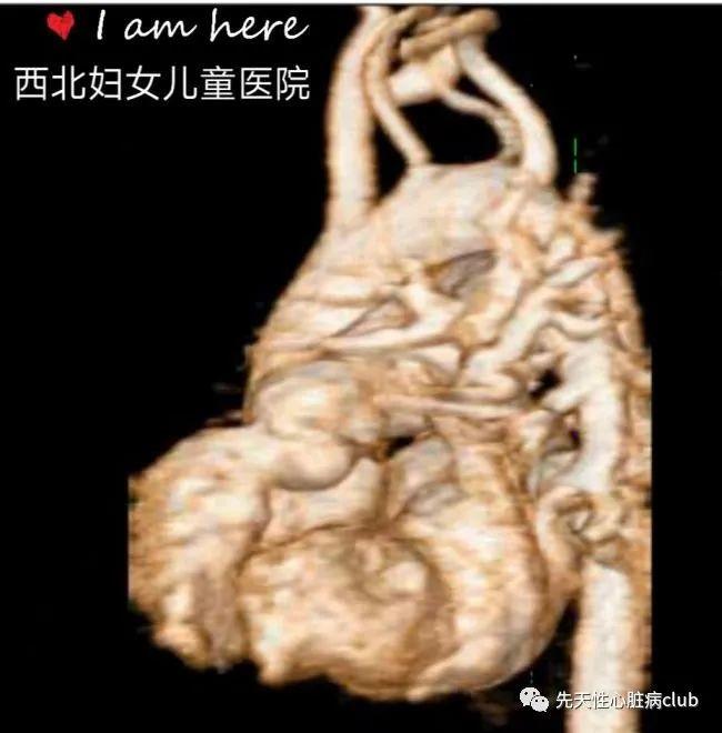 第十四篇:永存动脉干（PTA）