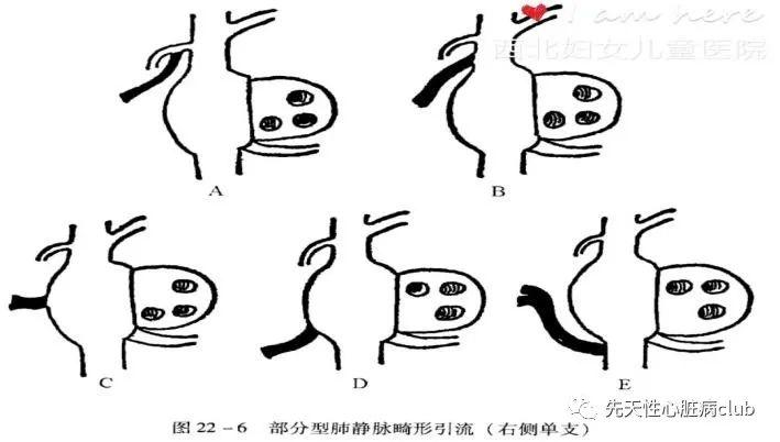 第二十七篇:部分型肺静脉异位引流（PAPVC）