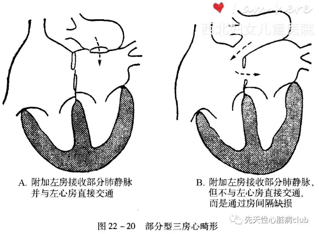 第二十六篇：三房心（cor triatriatum,CTA)