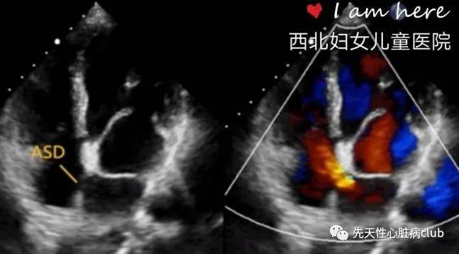 第二十六篇：三房心（cor triatriatum,CTA)