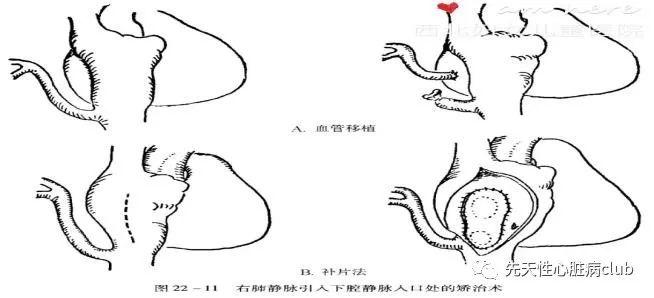 第二十七篇:部分型肺静脉异位引流（PAPVC）