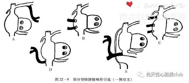第二十七篇:部分型肺静脉异位引流（PAPVC）