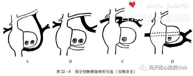 第二十七篇:部分型肺静脉异位引流（PAPVC）