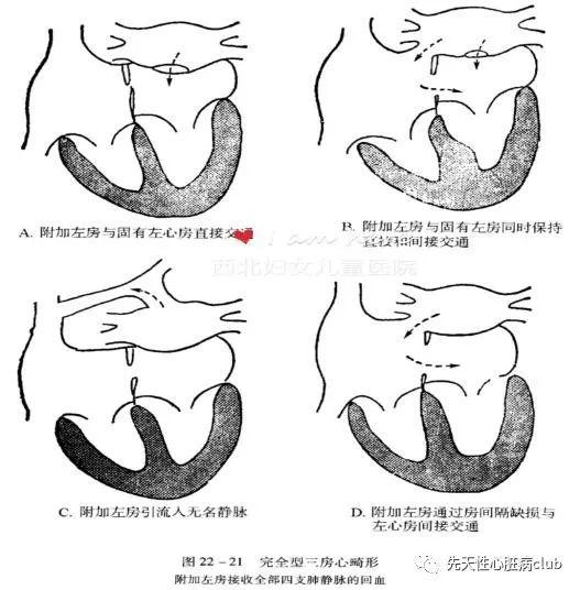 第二十六篇：三房心（cor triatriatum,CTA)