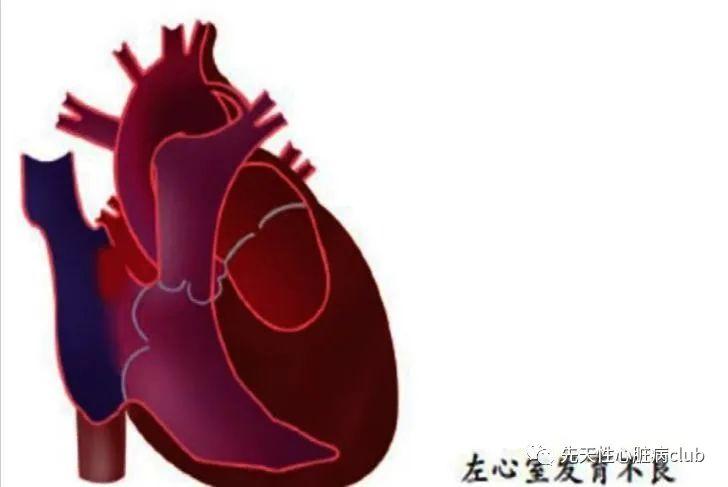 第三十二篇：左心发育不良综合症（HLHS）
