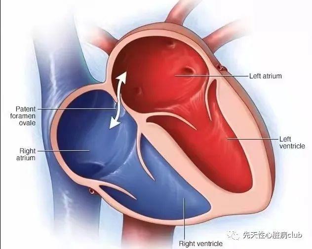 第三十九篇：胎儿卵圆孔过大、受限或早闭预后评估