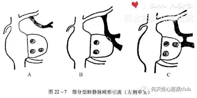 第二十七篇:部分型肺静脉异位引流（PAPVC）